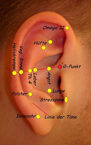 130.  Tinnitus Fall II, rechtes Ohr